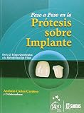 Paso A Paso En La Protesis Sobre Implante (Em Portuguese do Brasil)